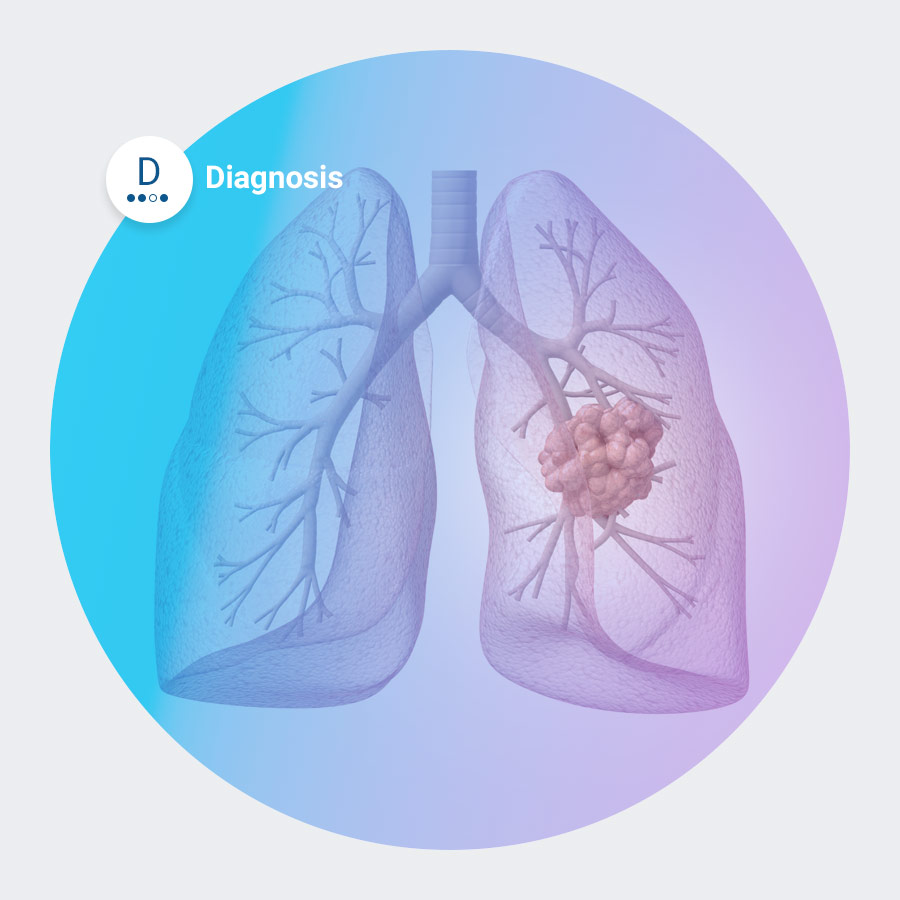 Diagnosing Lung Cancer